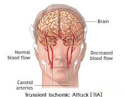 Symptoms of a mini stroke - loss of blood to brain