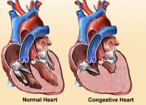Congested Heart Failure Symptoms - Enlarged Heart