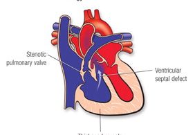 Tetralogy of Fallot - Congenital Heart Defects
